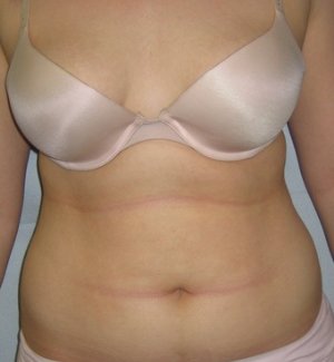 Manhattan liposuction before 1